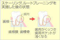 スケーリング、ルートプレーニングをジッシした後の状態