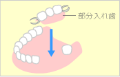 入れ歯